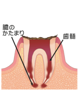 虫歯の進行段階と治療法 C4:　歯の根まで進行した虫歯