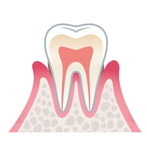 歯周病の進行段階 軽度歯周病