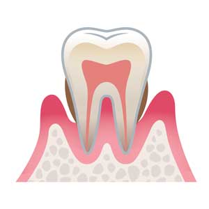 歯周病の進行段階 中度歯周病