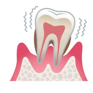歯周病の進行段階 重度歯周病